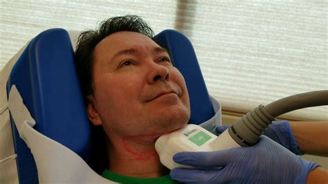 Coolsculpting Procedure To Treat Double Chin Youtube