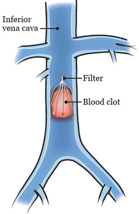 Inferior Vena Cava Anatomy Function Filter Inferior Vena Cava Syndrome