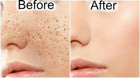 How To Reduce Large Pores Permanently With Only 1 Ingredient Youtube
