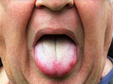 How To Get Rid Of White Coated Tongue With Simple Home