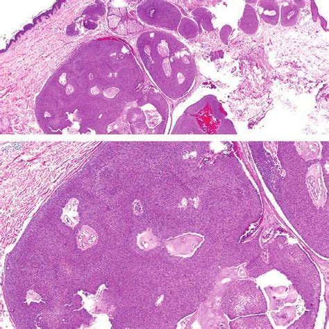 A And B Histopathology Of Eccrine Porocarcinoma Lobular Infiltrative