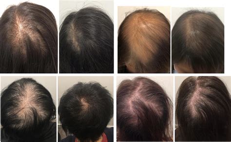 Hair Loss In Peri Menopausal Women