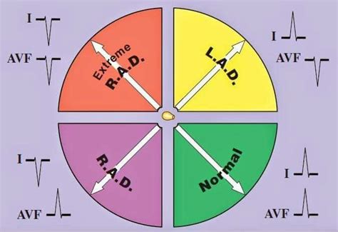 Using leads i and avf the axis can be calculated to within one of the four quadrants at a glance. Axis deviation | Nurse practitioner school, Cardiac ...