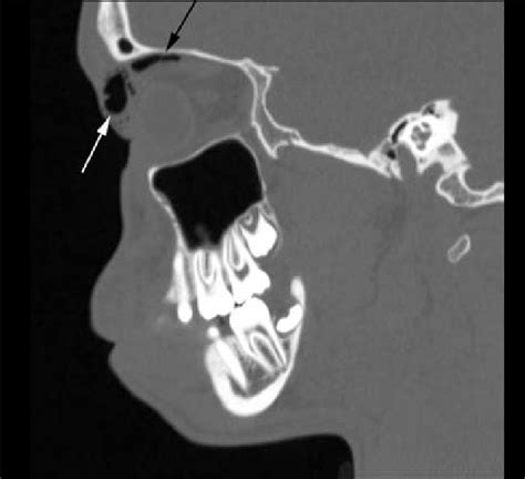 Sagittally Reformatted Ct Shows Orbital Emphysema Arrows Download