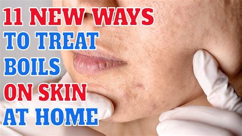 Boils On Skin How To Get Rid Of Them How Long Do Boils Last On Skin