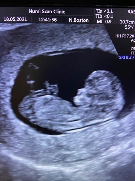 Early Pregnancy Scans Why Have One Numi Scan Gender Scan Muswell