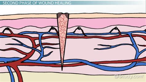Stages Of Wound Healing Overview Process And Timeline Lesson