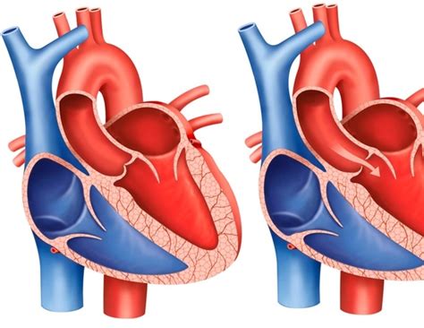 What Is Aortic Stenosis
