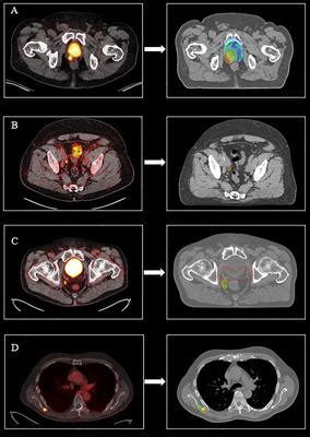 Frontiers PET CT Based Salvage Radiotherapy For Recurrent Prostate Cancer After Radical