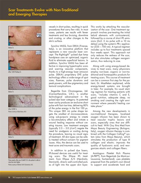Effective Scar Treatment With Oxy Xtra Med By Mbe Medical Division