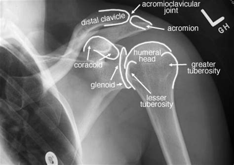 The jugular notch is the thickest part of the bone and is. Radiographic Anatomy of the Skeleton: Shoulder -- Internal ...