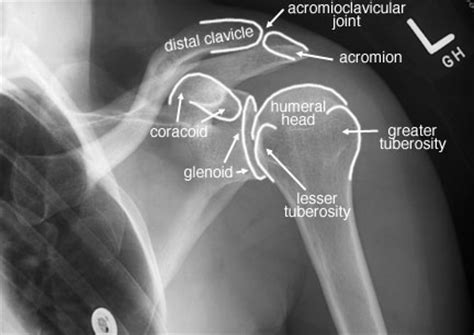 The disk has a great variation in size and shape and eventually undergoes rapid degeneration until it is. 공부하는 물리치료 | X-ray UPPER EXTREMITY - Daum 카페