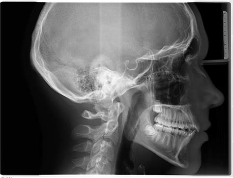 Telerradiografía lateral de cráneo Cráneo Ortodoncia Tratamiento de ortodoncia y Radiología