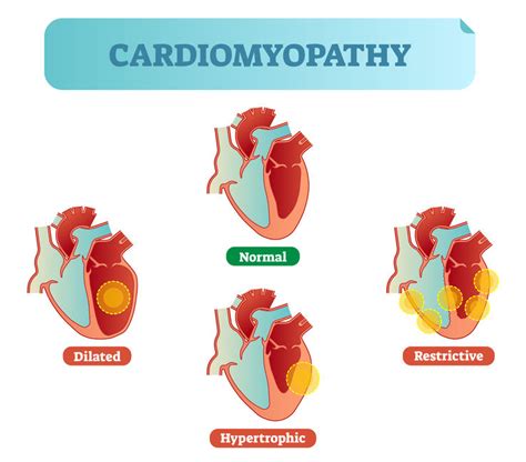 What Is Cardiomyopathy Symptoms And Treatment Pulse Cardiology