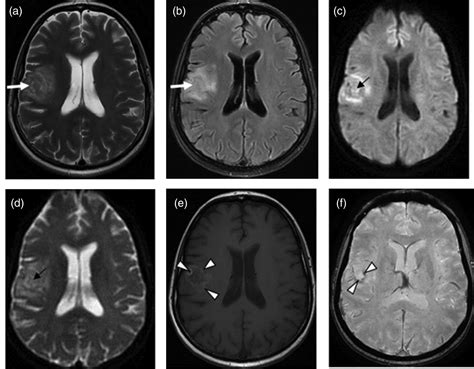 Cerebral Toxoplasmosis In Hiv Infected Patients Over 20152018 A Case