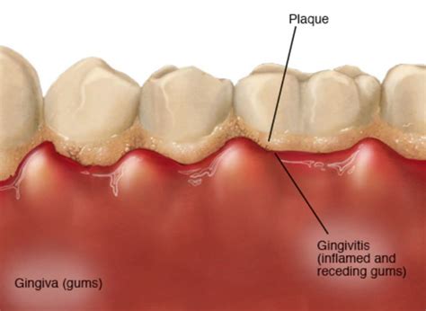 How To Know If You Have Gum Disease French Dental Service Dubai