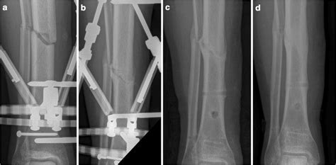 Clinical Healing Oblique Tibial And Fibular Diaphyseal Fractures