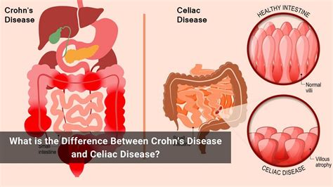 What Is The Difference Between Crohns Disease And Celiac Disease