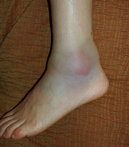 Swollen Ankle After Running New Health Advisor