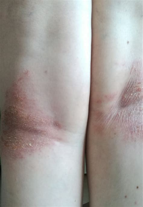 Dermatite Atopica Cause E Rimedi Naturali Senza Linea Hot Sex Picture