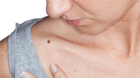 Women With A Lot Of Moles May Be At Higher Risk Of Breast Cancer