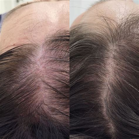 Плазмотерапия cortexil prp Процедура Кортексил ПРП терапия для лица и волос Цены на