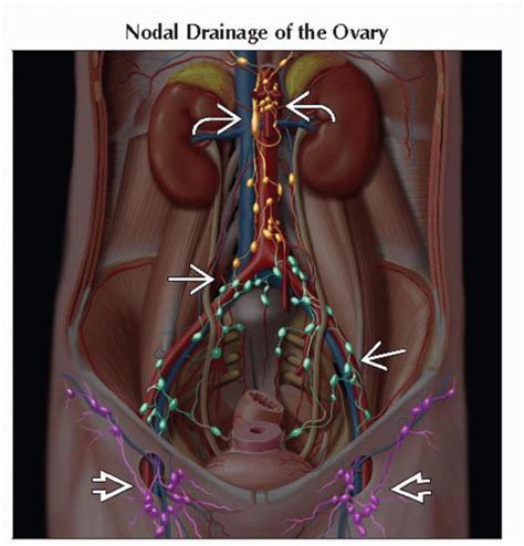 Ovarian Carcinoma Radiology Key