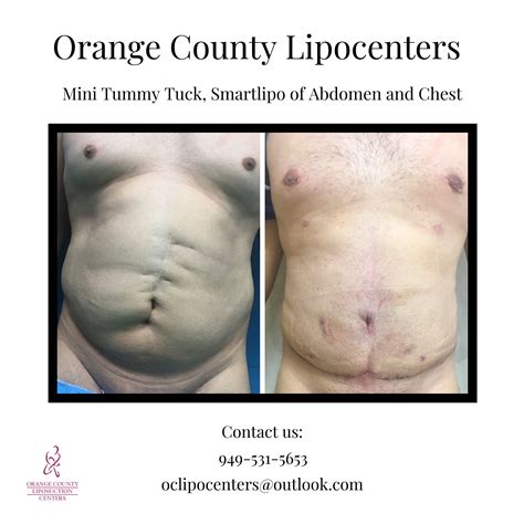 male patient had a orange county liposuction centers