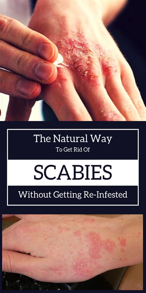 90 Amazing Can You See Scabies Mites On Skin Insectza