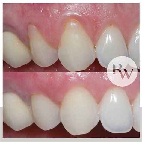 Gum Contouring And Gum Grafts Before And After Transformation Hello