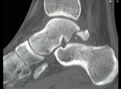 Talus Fracture Orthopedics Medbullets Step 23