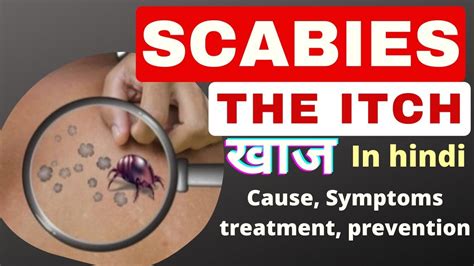 scabies in hindi the itch cause symptoms treatment खुजली msn gnm bsc nursing 2nd