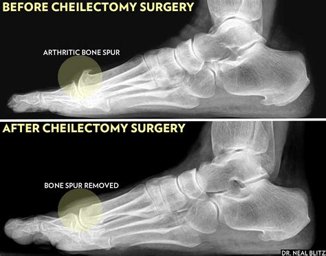Cheilectomy Big Toe Bone Spur Surgery And Recovery