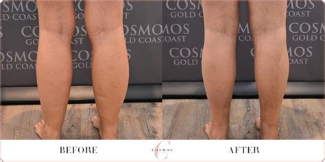 Knees Calves And Ankles Vaser Liposuction Before And After