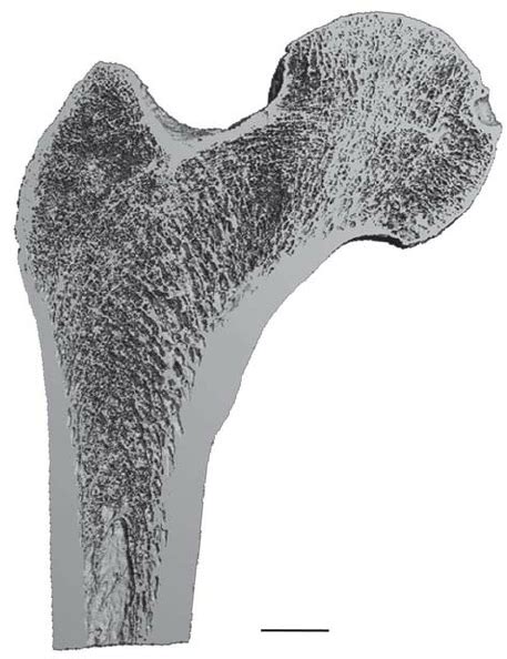 Porous Trabecular And Dense Cortical Bone In A Proximal Human Femur As
