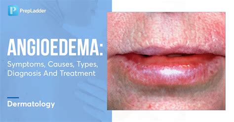 Angioedema Symptoms Causes Types Diagnosis And Treatment