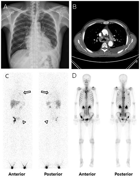 Metastatic Prostate Cancer Initially Presenting As Chylothorax A Case