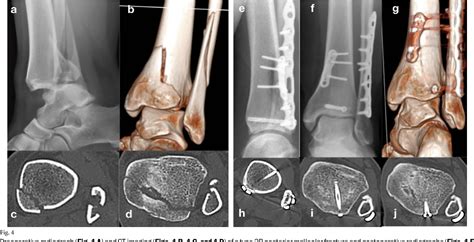 Figure From Posterior Malleolar Ankle Fractures Semantic Scholar