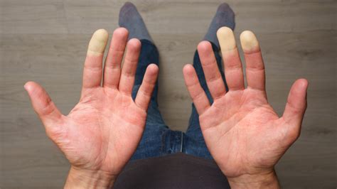 Raynauds Disease Symptoms Causes Risk Factors And Treatment Options