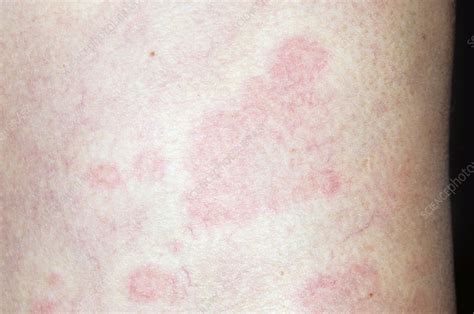 Urticaria Hives On The Body Stock Image C0085606 Science Photo