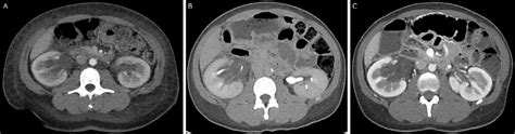 A Axial View Of Venous Phase Contrast Enhanced Ct Obtained
