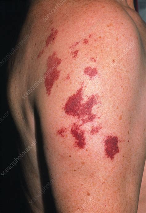 Port Wine Stain On Arm Stock Image M2200058 Science Photo Library