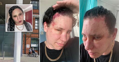 Grans Head Ballooned And Skin Erupted In Rash After Severe Hair Dye Reaction