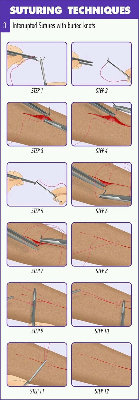 Pin By Linksoutside On Suture Methods Medical Education Suture