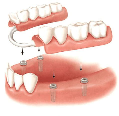 Implant Supported Removable Partial Denture
