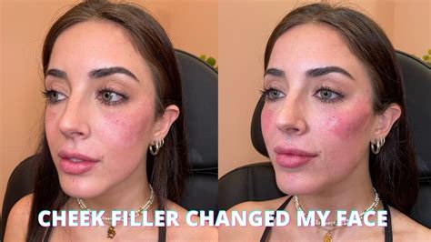 Watch Me Get Cheek Filler My Experience Before And After Juvederm
