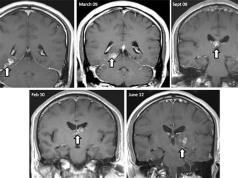 A Rare 10cm Long Tapeworm Lived In A Mans Brain For Four Years Before