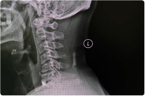 Cervical Spondylosis X Ray Image