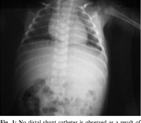 Figure From Subgaleal Migration Of The Distal Catheter Of A Ventriculoperitoneal Shunt