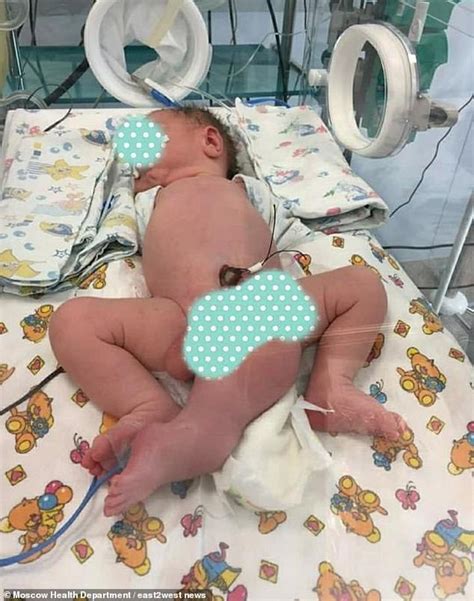Doctors Save Baby Boy Born With Three Legs Two Penises And No Anus